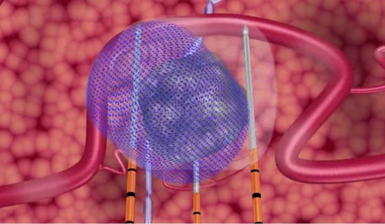 NanoKnife: En Güncel Prostat Kanseri Tedavisi